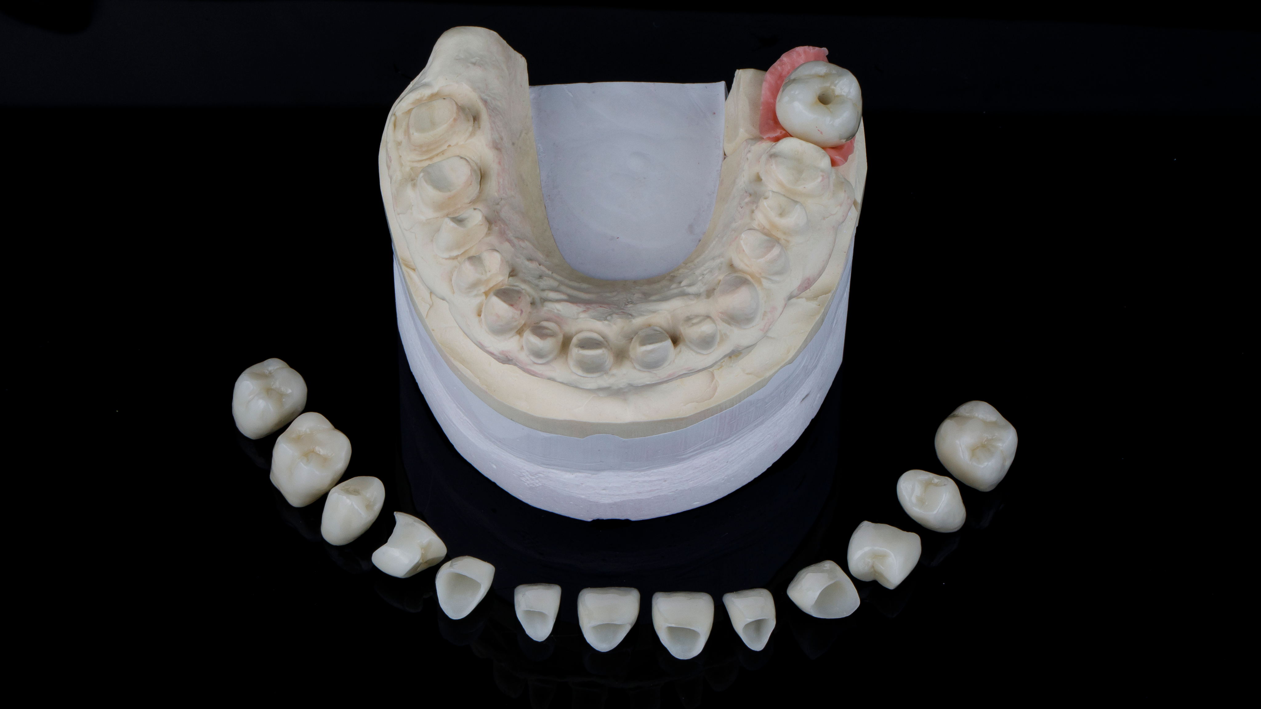 Monolithic Multilayer Zirconia Crowns in the Esthetic Zone