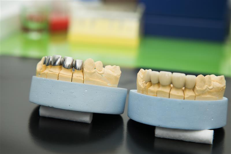 Dental Crown Materials